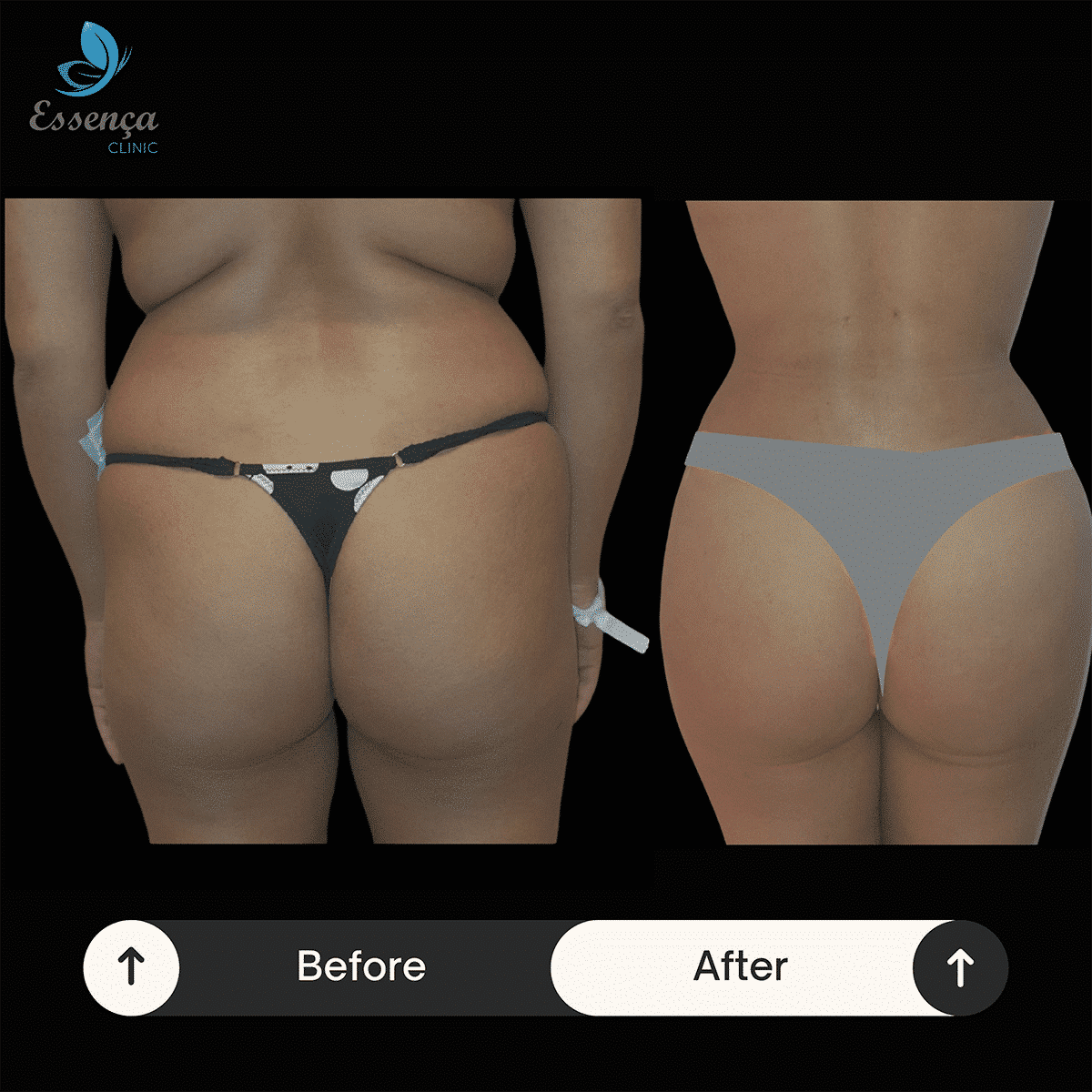 Before After Dr. Burak Efeoğlu (3)-min