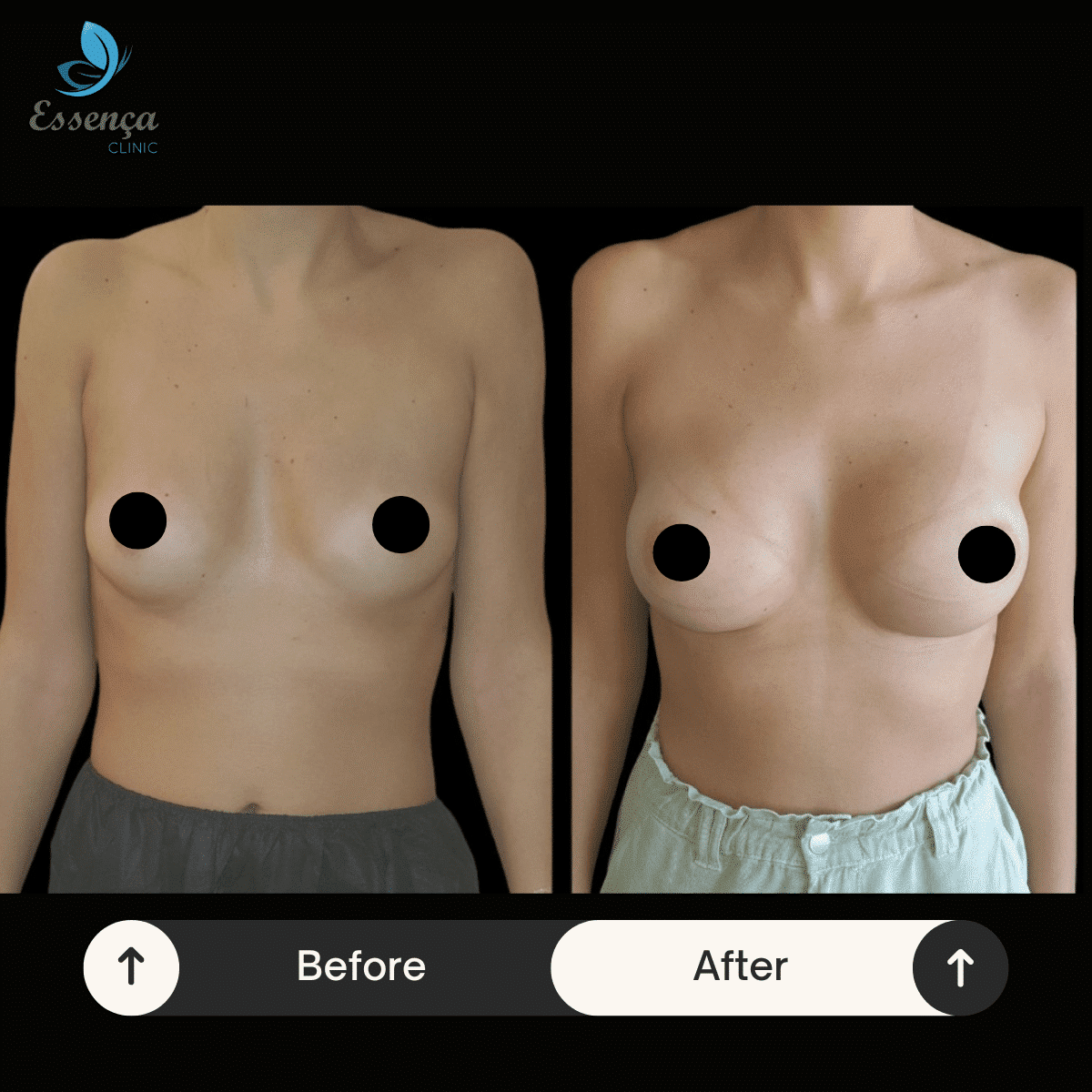 Before After Dr. Burak Efeoğlu (32)-min
