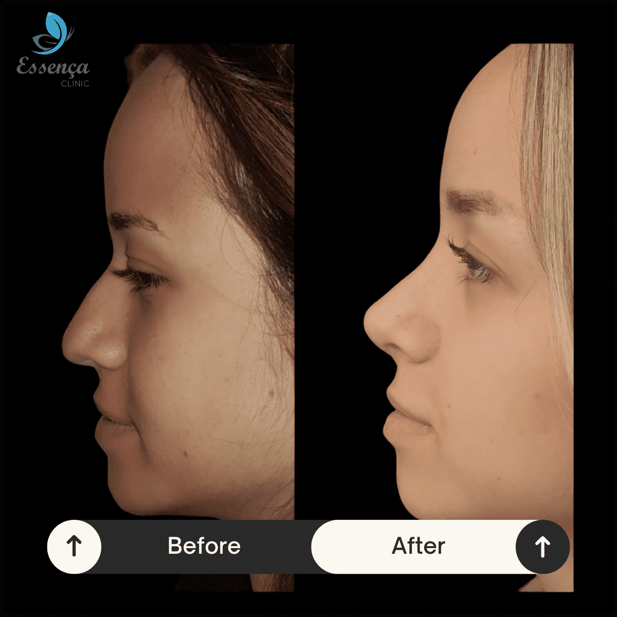 Before After Dr. Burak Efeoğlu (41)-min