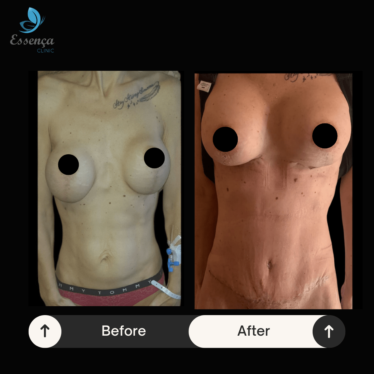 Before After Dr. Burak Efeoğlu (44)-min