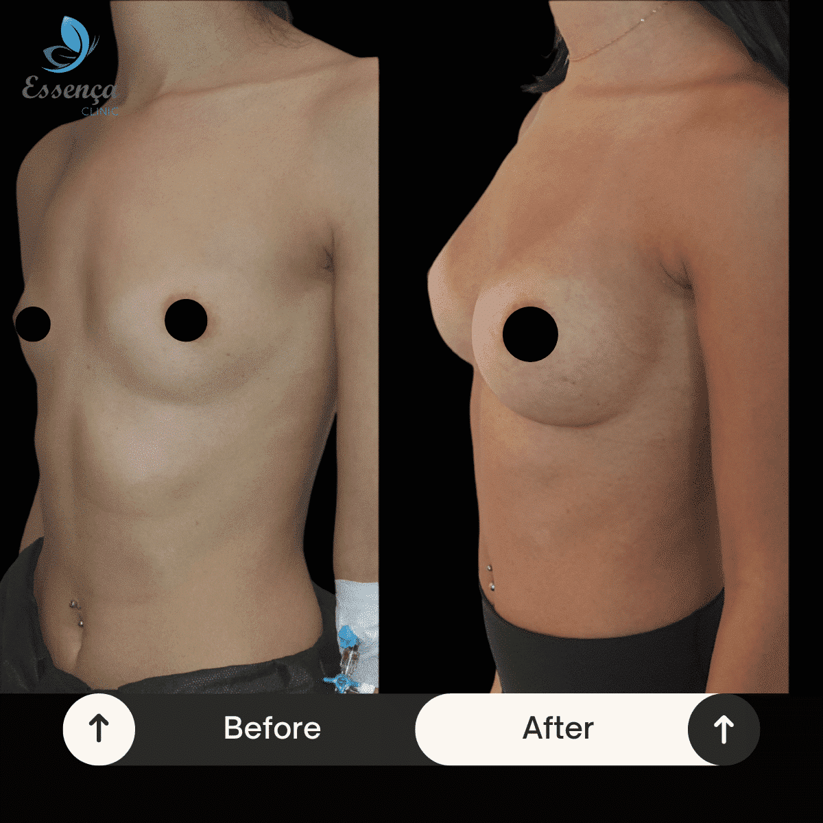 Before After Dr. Burak Efeoğlu (45)-min