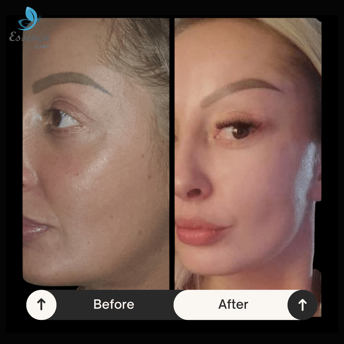 Before After Dr. Burak Efeoğlu (46)-min