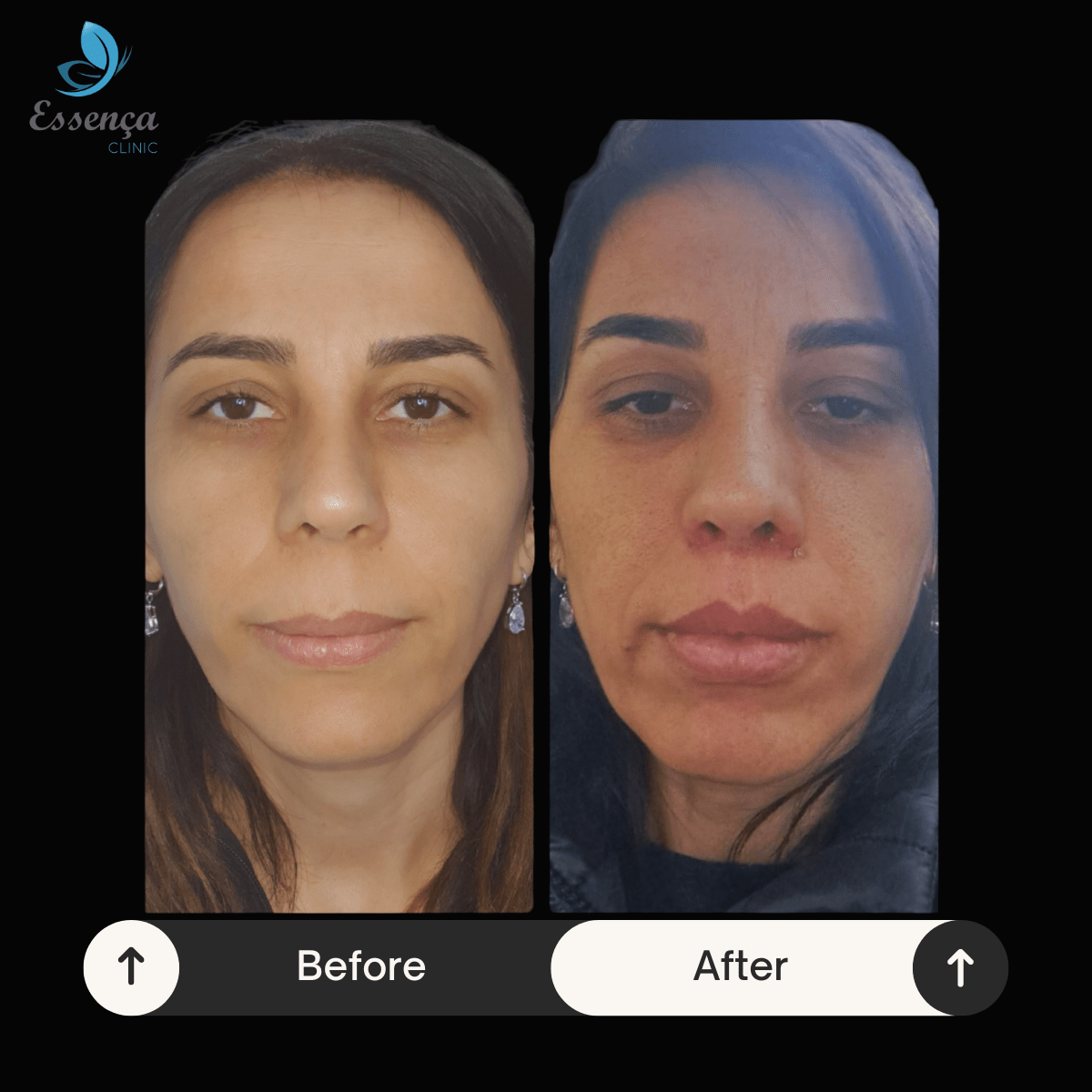 Before After Dr. Burak Efeoğlu (47)-min