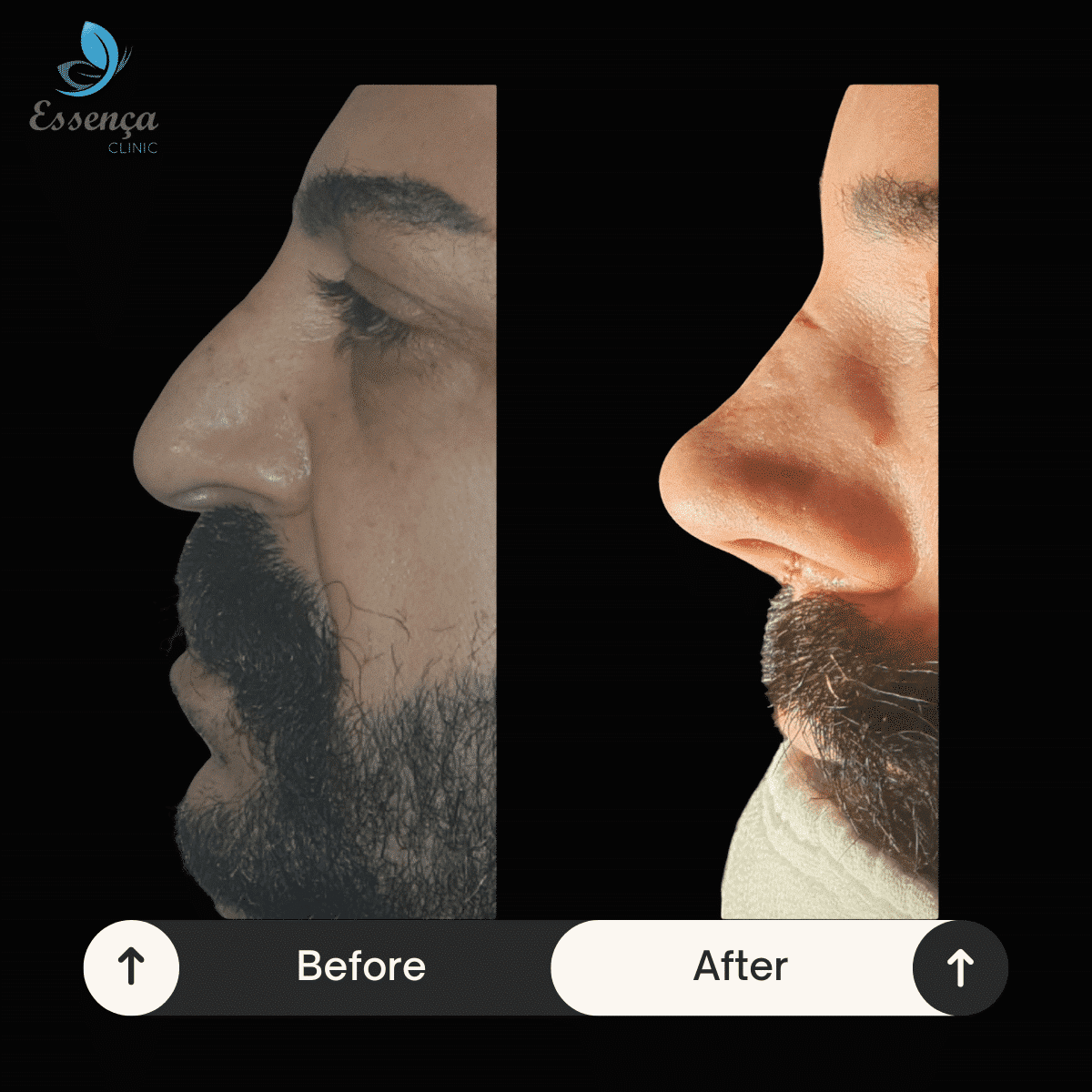 Before After Dr. Burak Efeoğlu (50)-min