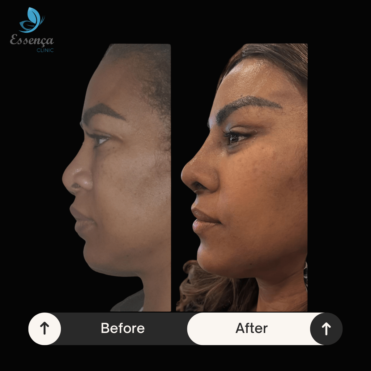 Before After Dr. Burak Efeoğlu (52)-min