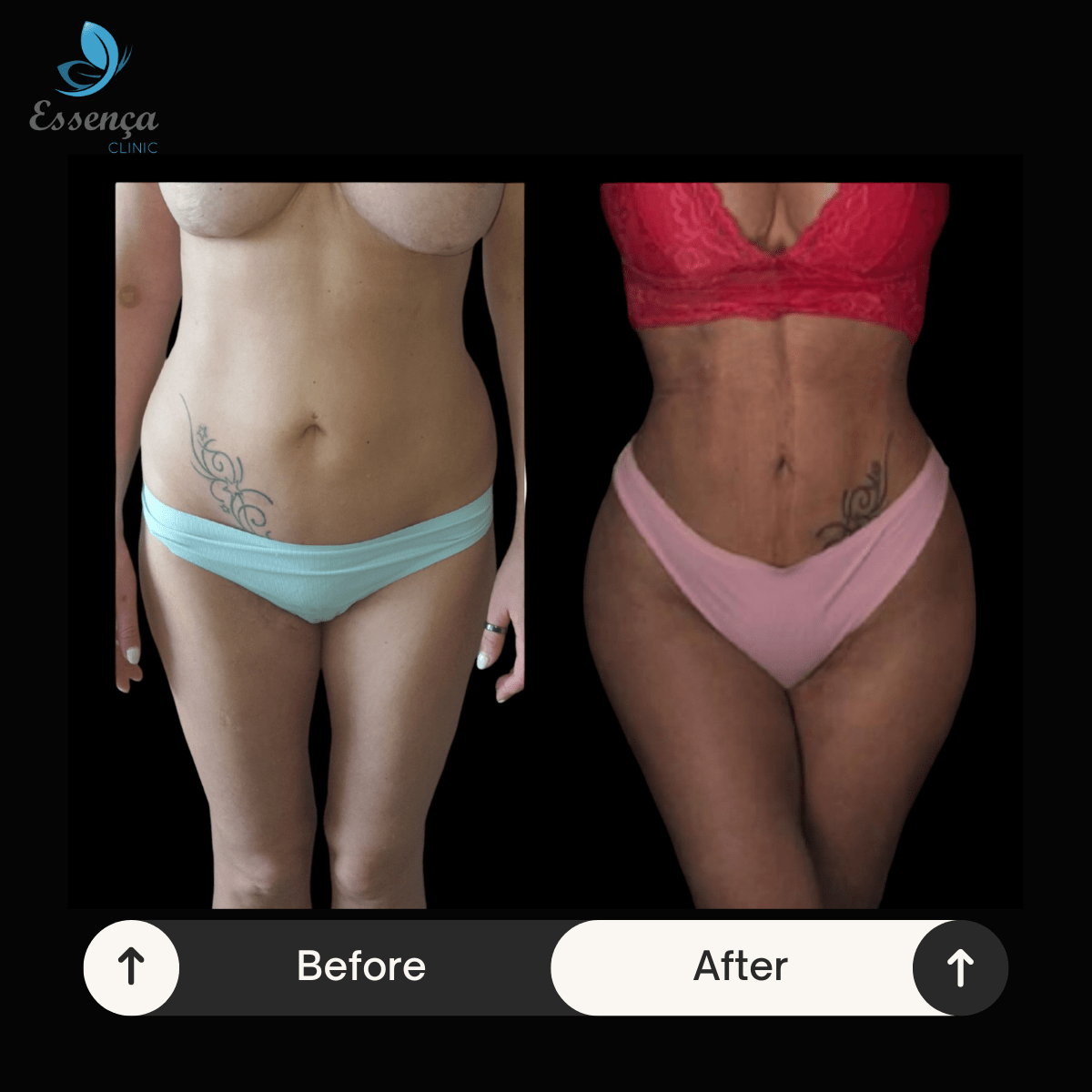 Before After Dr. Burak Efeoğlu (55)-min