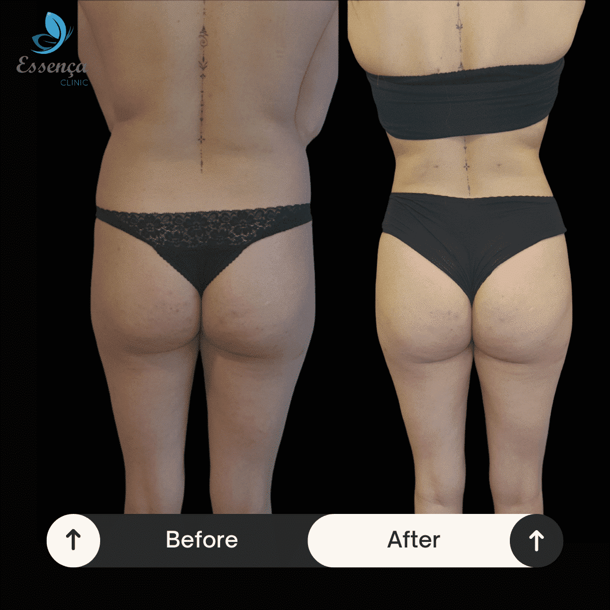 Before After Dr. Burak Efeoğlu (58)-min