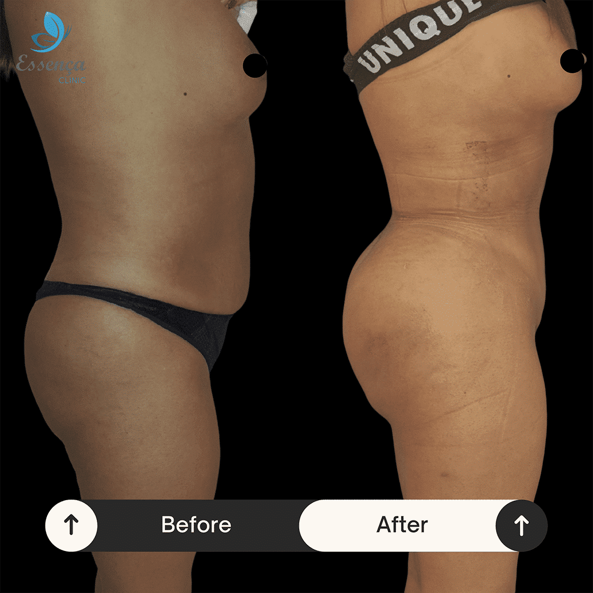 Before After Dr. Burak Efeoğlu (6)-min