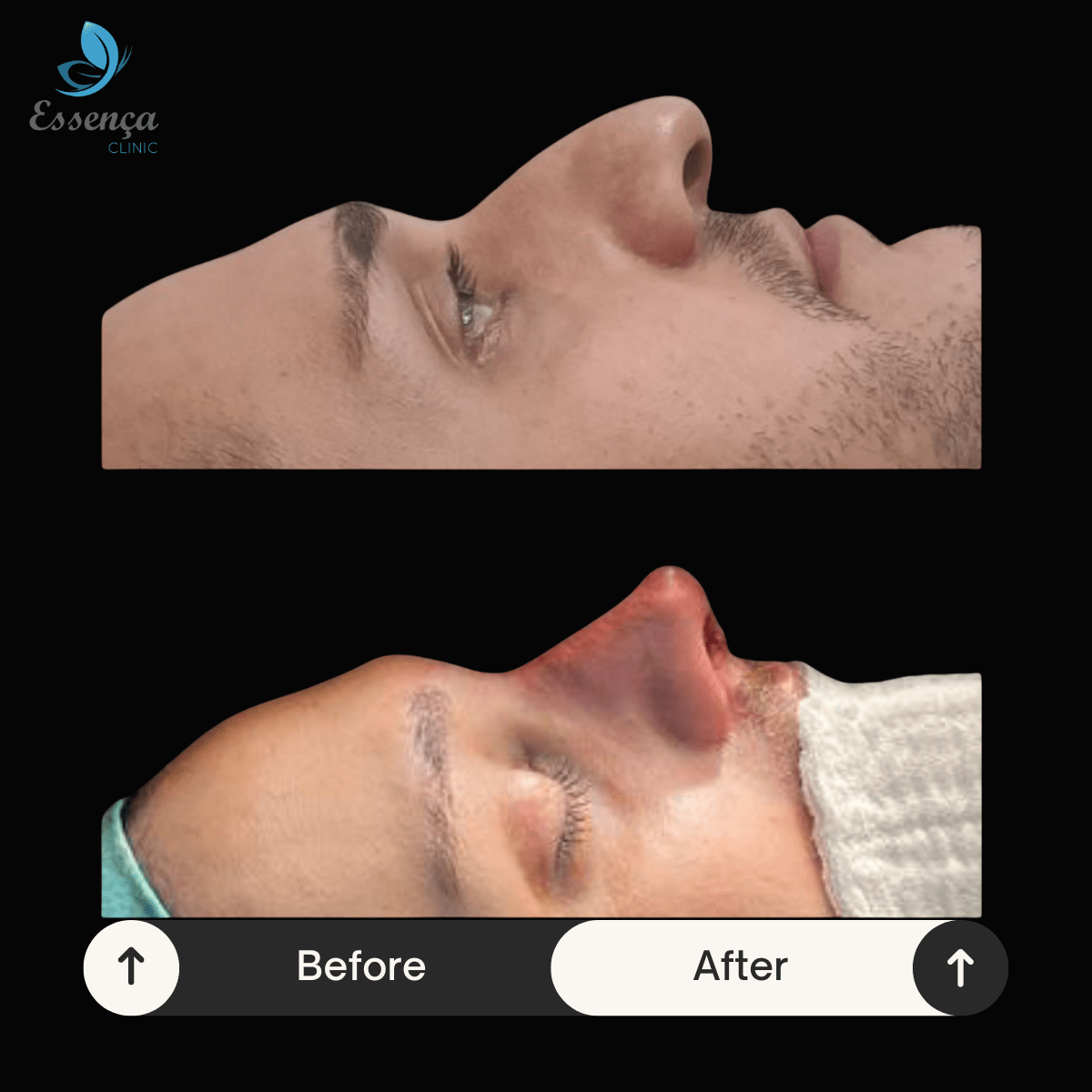 Before After Dr. Burak Efeoğlu (61)-min