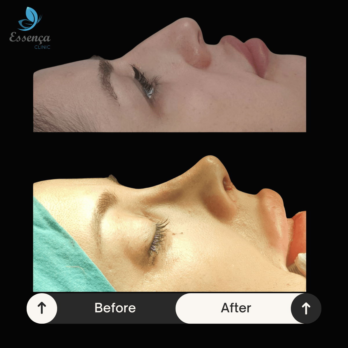 Before After Dr. Burak Efeoğlu (62)-min