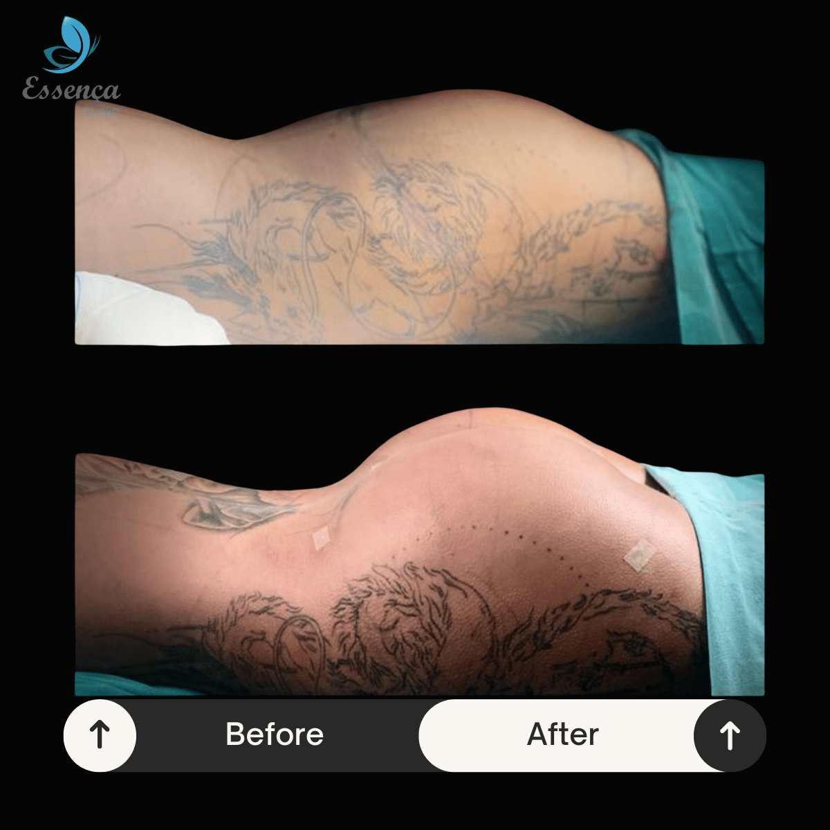 Before After Dr. Burak Efeoğlu (64)-min