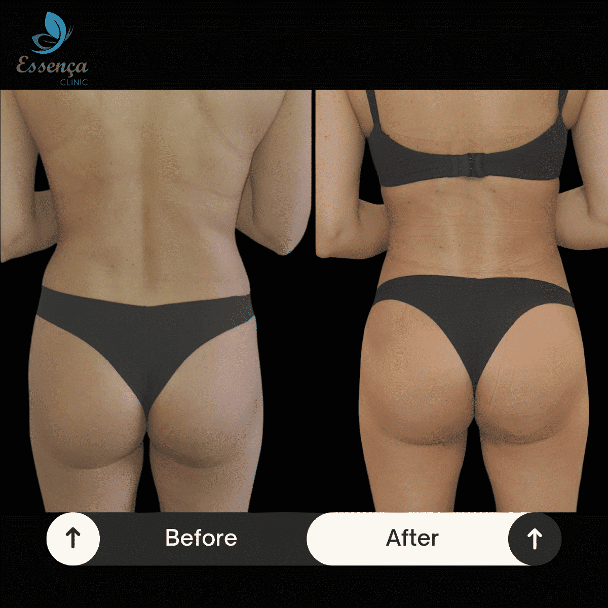 Before After Dr. Burak Efeoğlu (66)-min