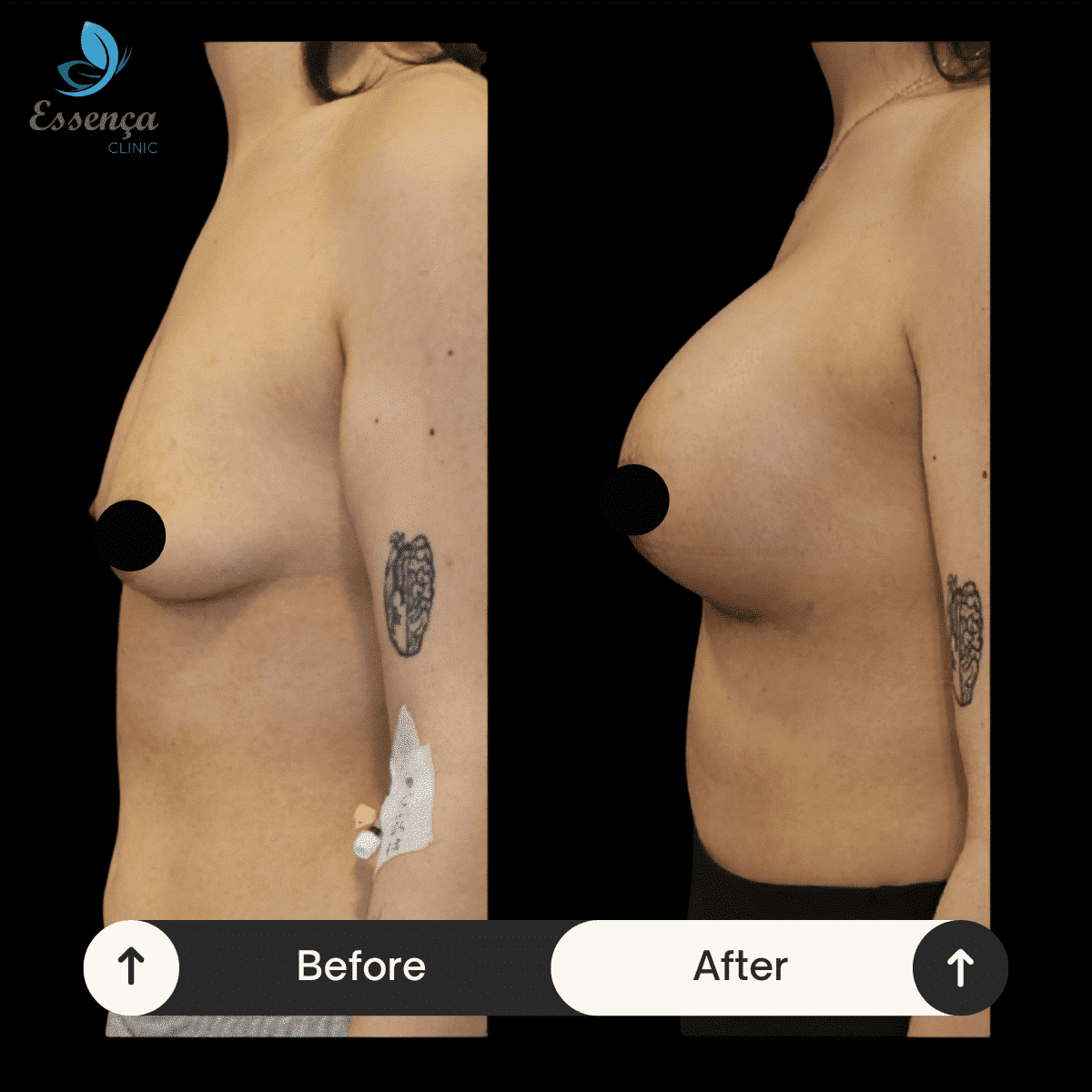 Before After Dr. Burak Efeoğlu (70)-min