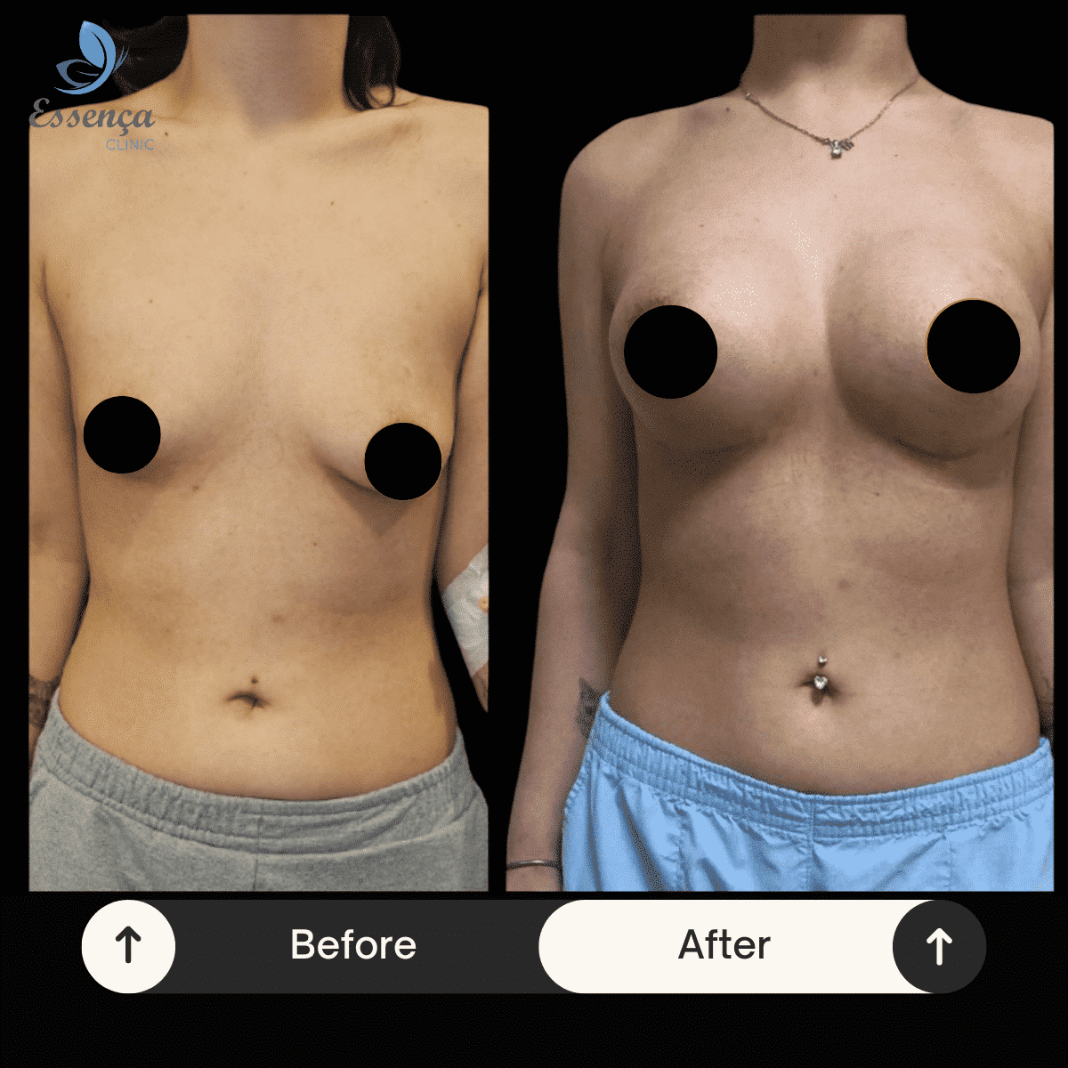 Before After Dr. Burak Efeoğlu (72)-min