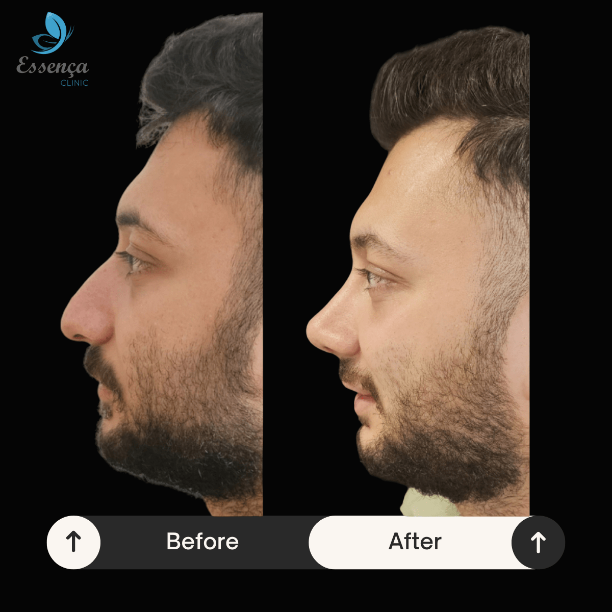 Before After Dr. Burak Efeoğlu (75)-min