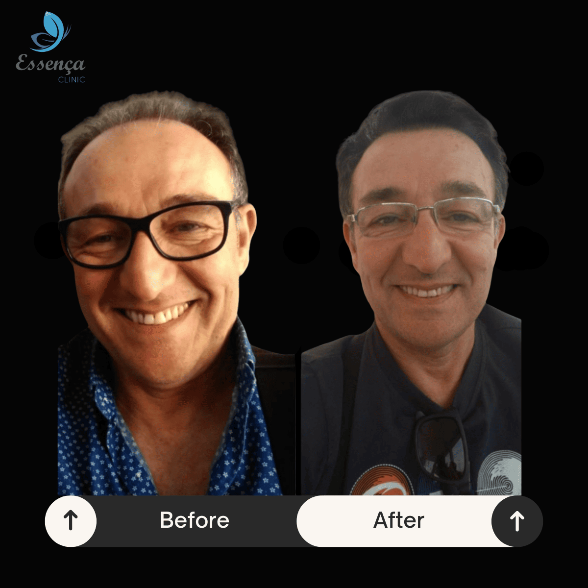 Before After Dr. Mehmet Kapçın (1)