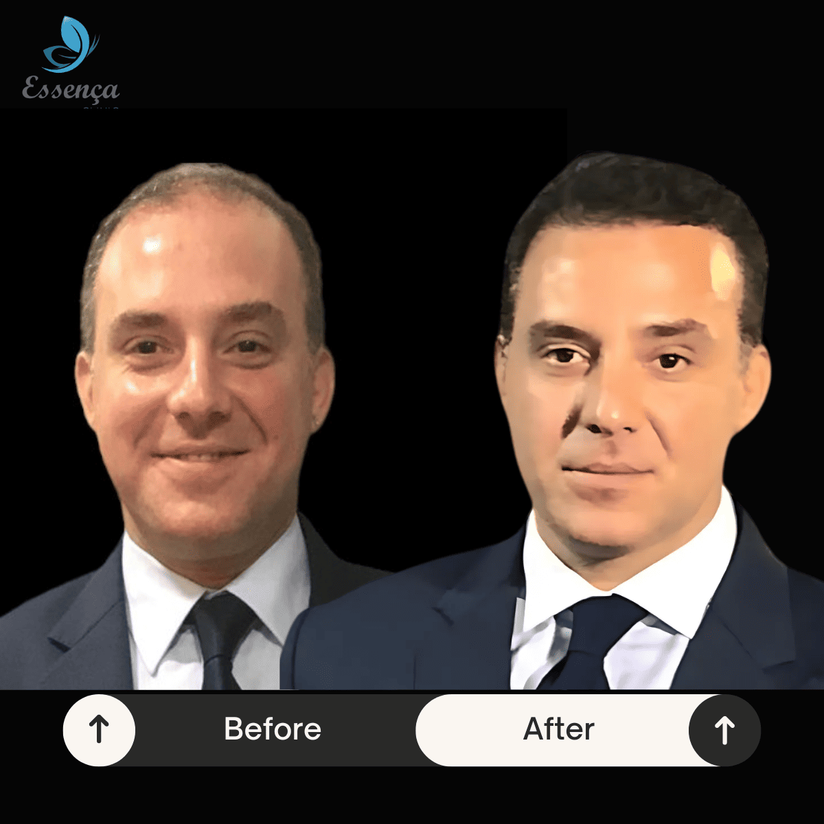 Before After Dr. Mehmet Kapçın (10)