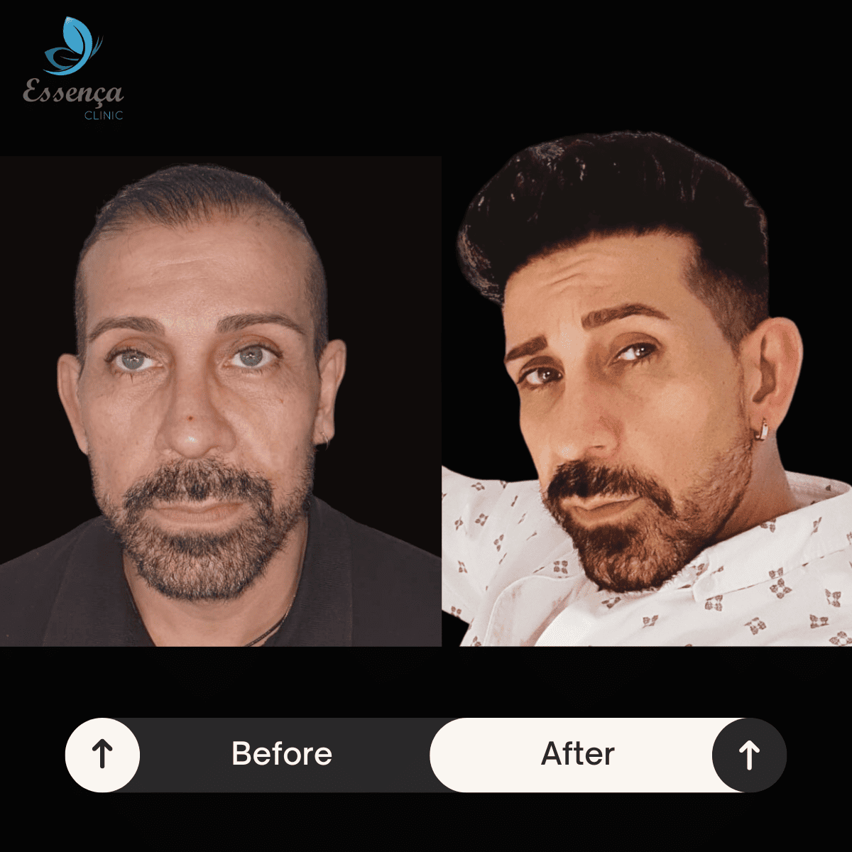 Before After Dr. Mehmet Kapçın (11)