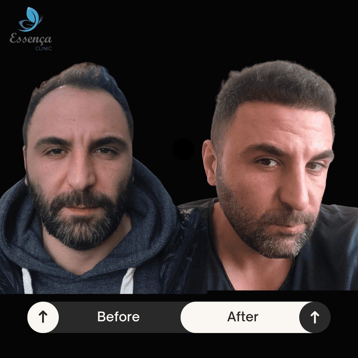 Before After Dr. Mehmet Kapçın (12)