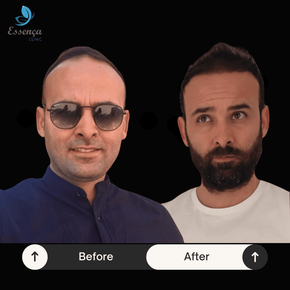 Before After Dr. Mehmet Kapçın (14)