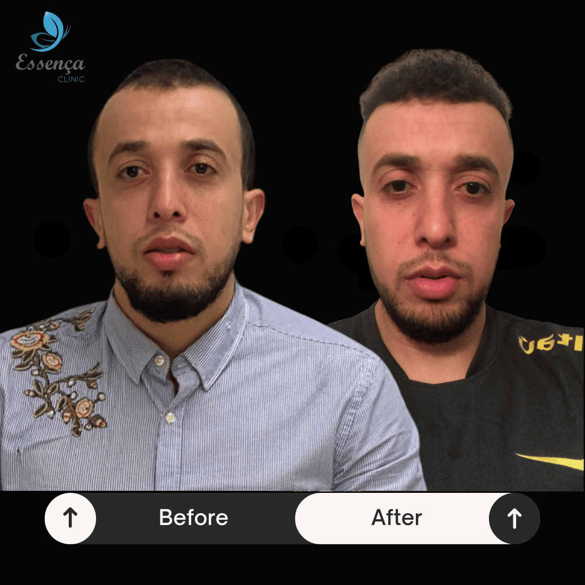 Before After Dr. Mehmet Kapçın (15)