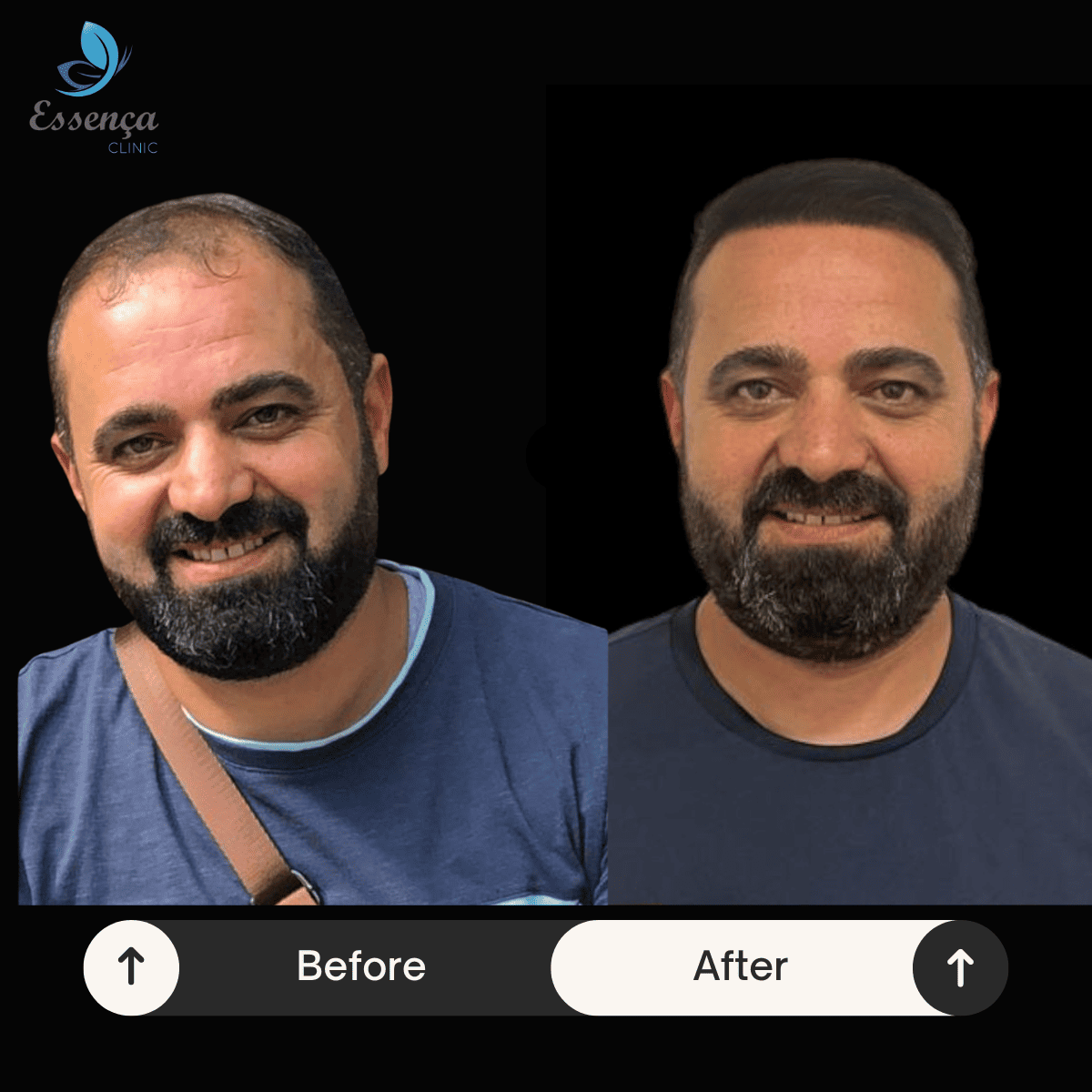 Before After Dr. Mehmet Kapçın (16)