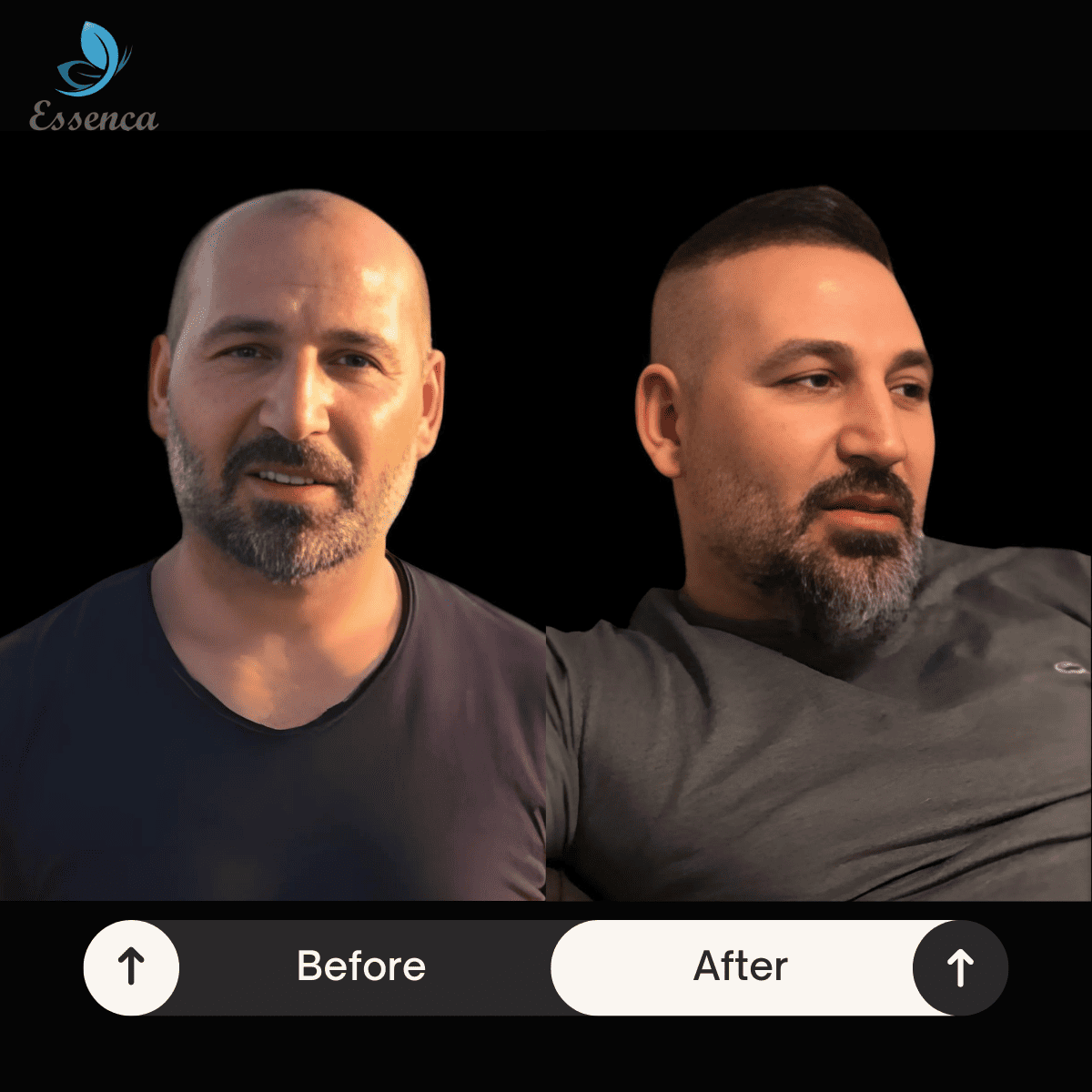 Before After Dr. Mehmet Kapçın (17)