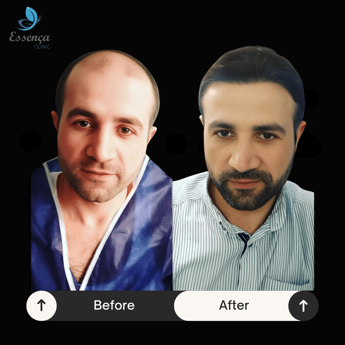 Before After Dr. Mehmet Kapçın (2)
