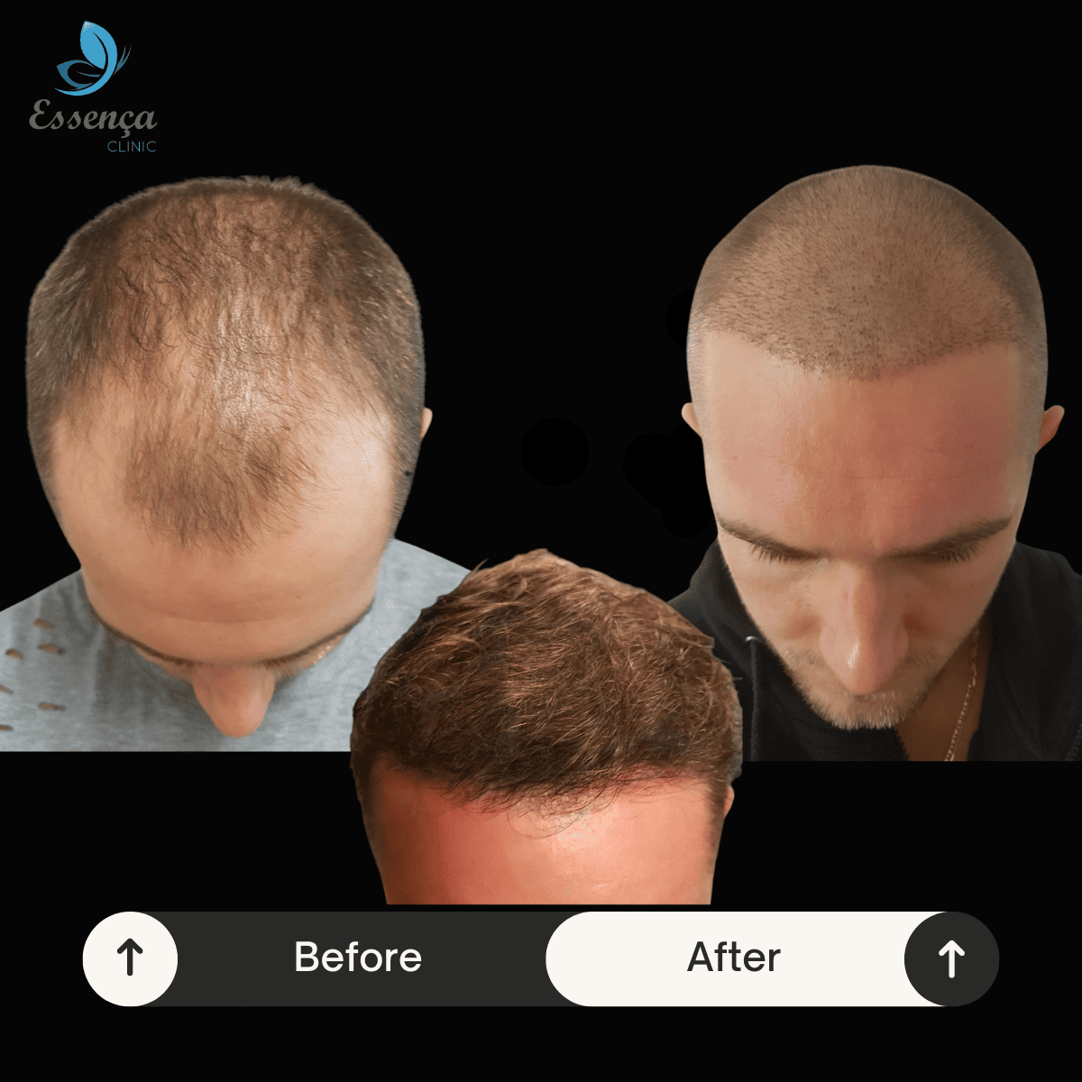 Before After Dr. Mehmet Kapçın (21)