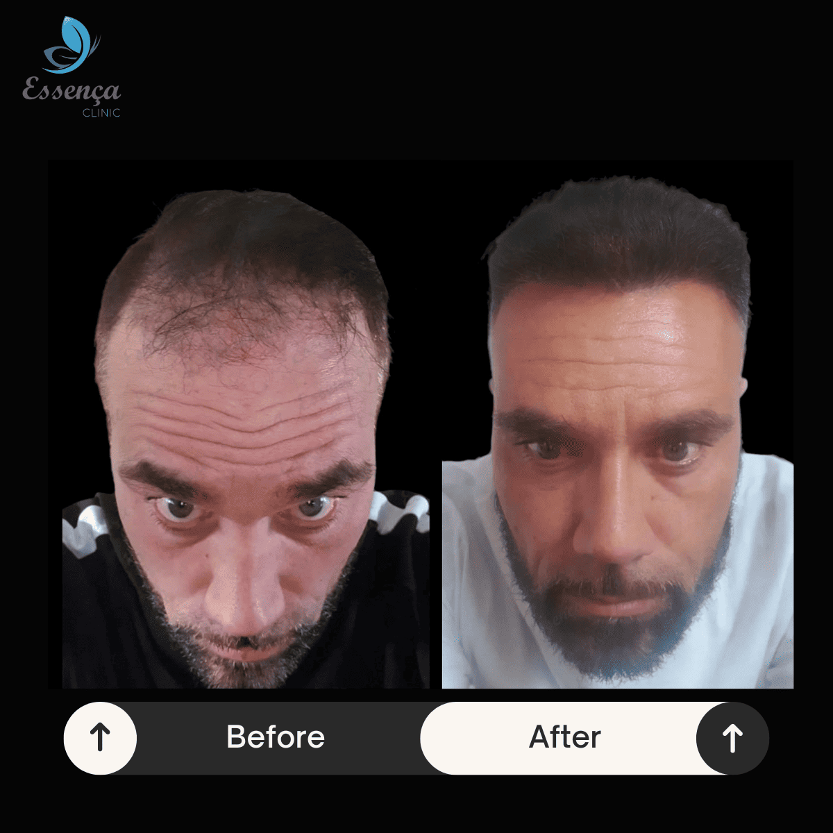 Before After Dr. Mehmet Kapçın (22)