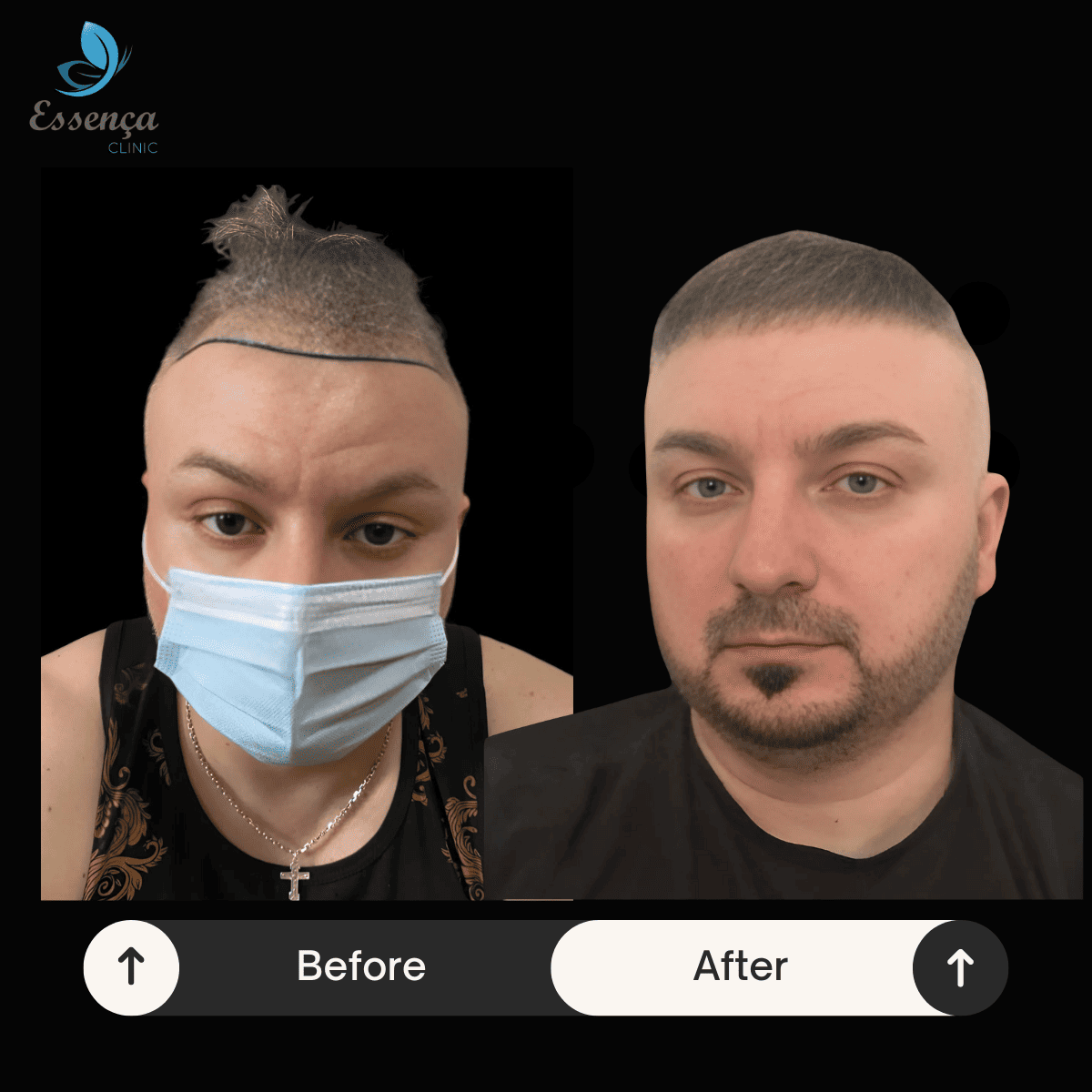 Before After Dr. Mehmet Kapçın (23)