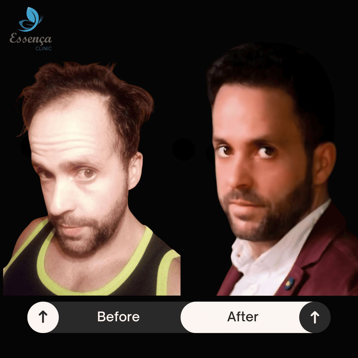 Before After Dr. Mehmet Kapçın (24)