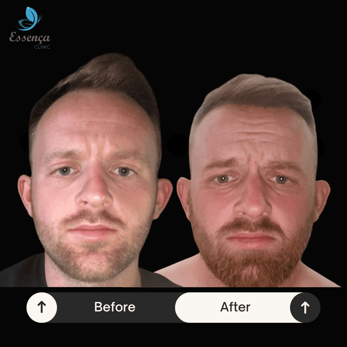 Before After Dr. Mehmet Kapçın (25)