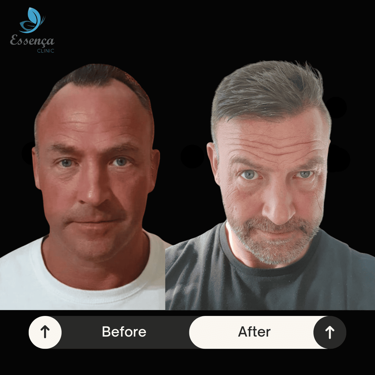 Before After Dr. Mehmet Kapçın (27)