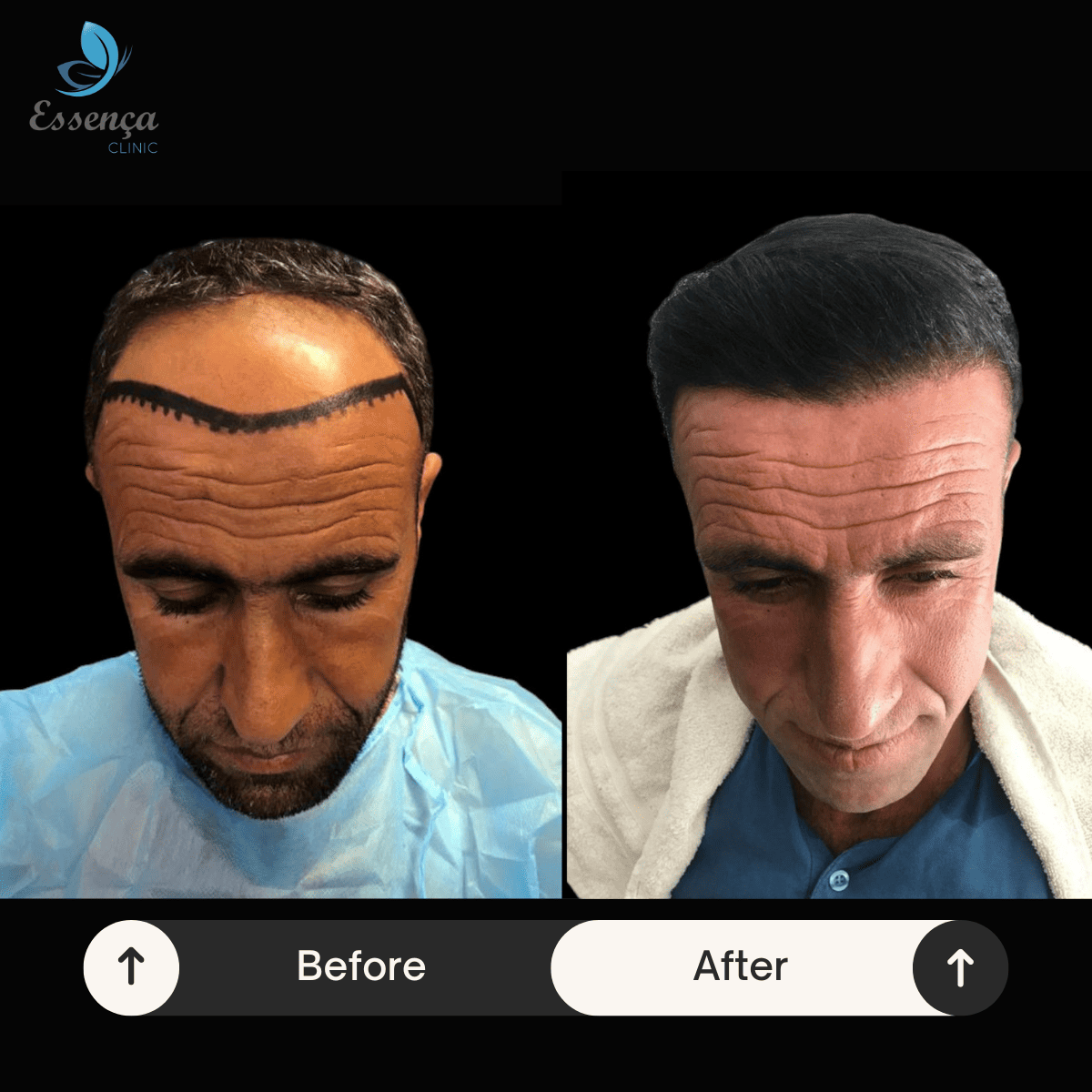 Before After Dr. Mehmet Kapçın (29)