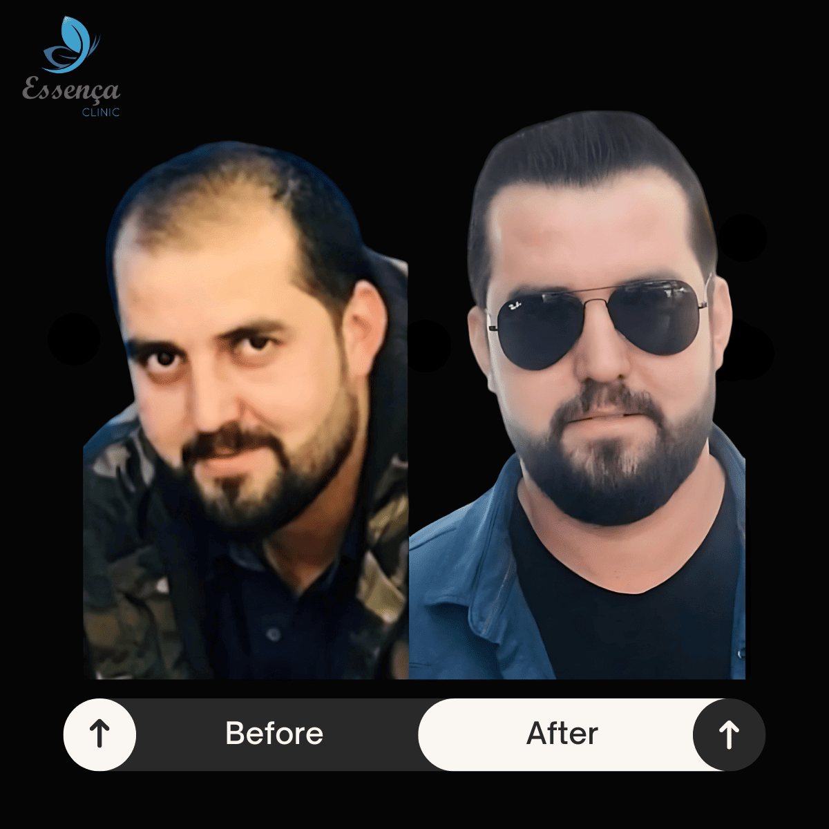 Before After Dr. Mehmet Kapçın (3)