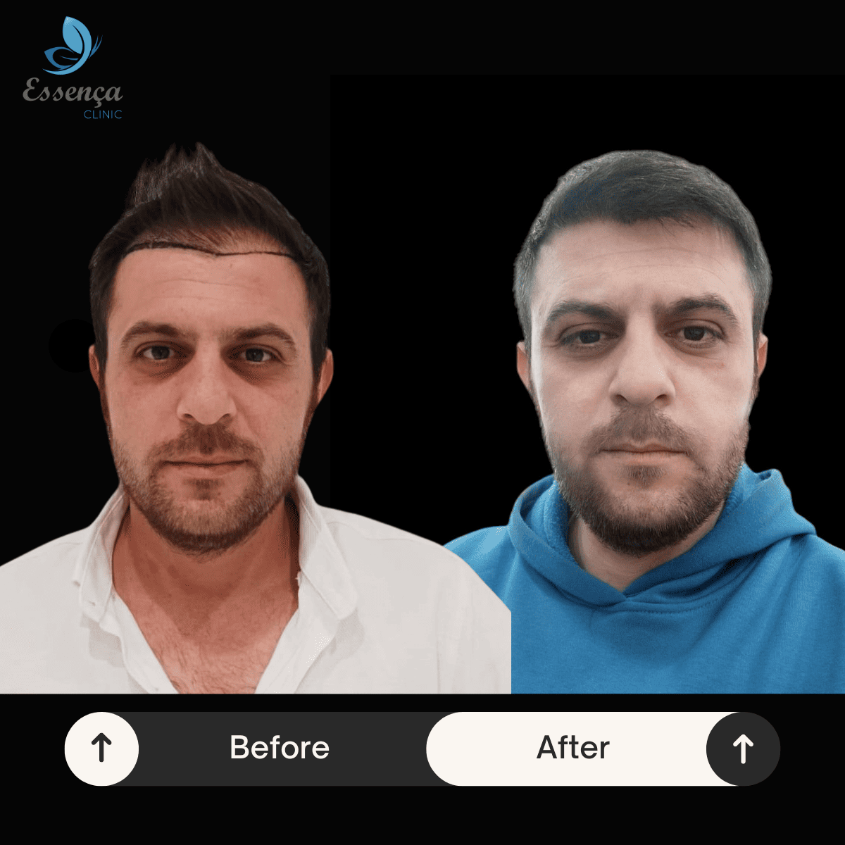 Before After Dr. Mehmet Kapçın (30)