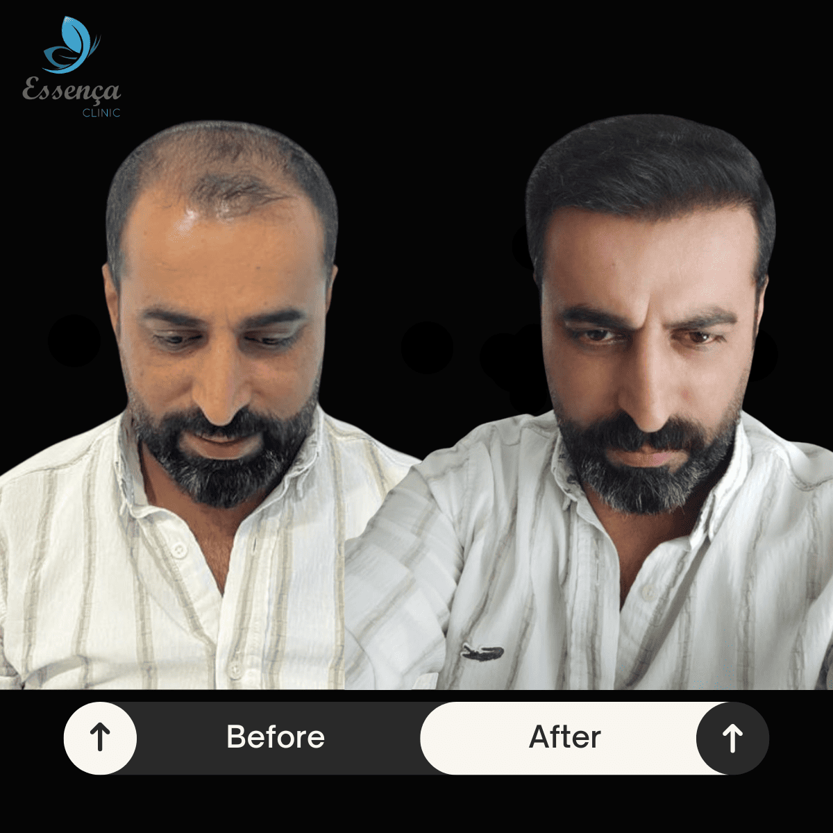 Before After Dr. Mehmet Kapçın (31)