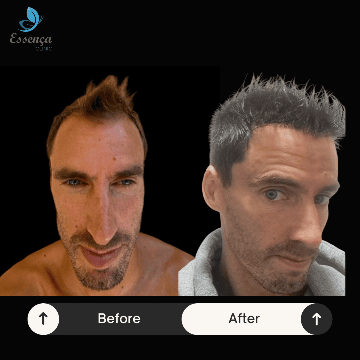 Before After Dr. Mehmet Kapçın (41)