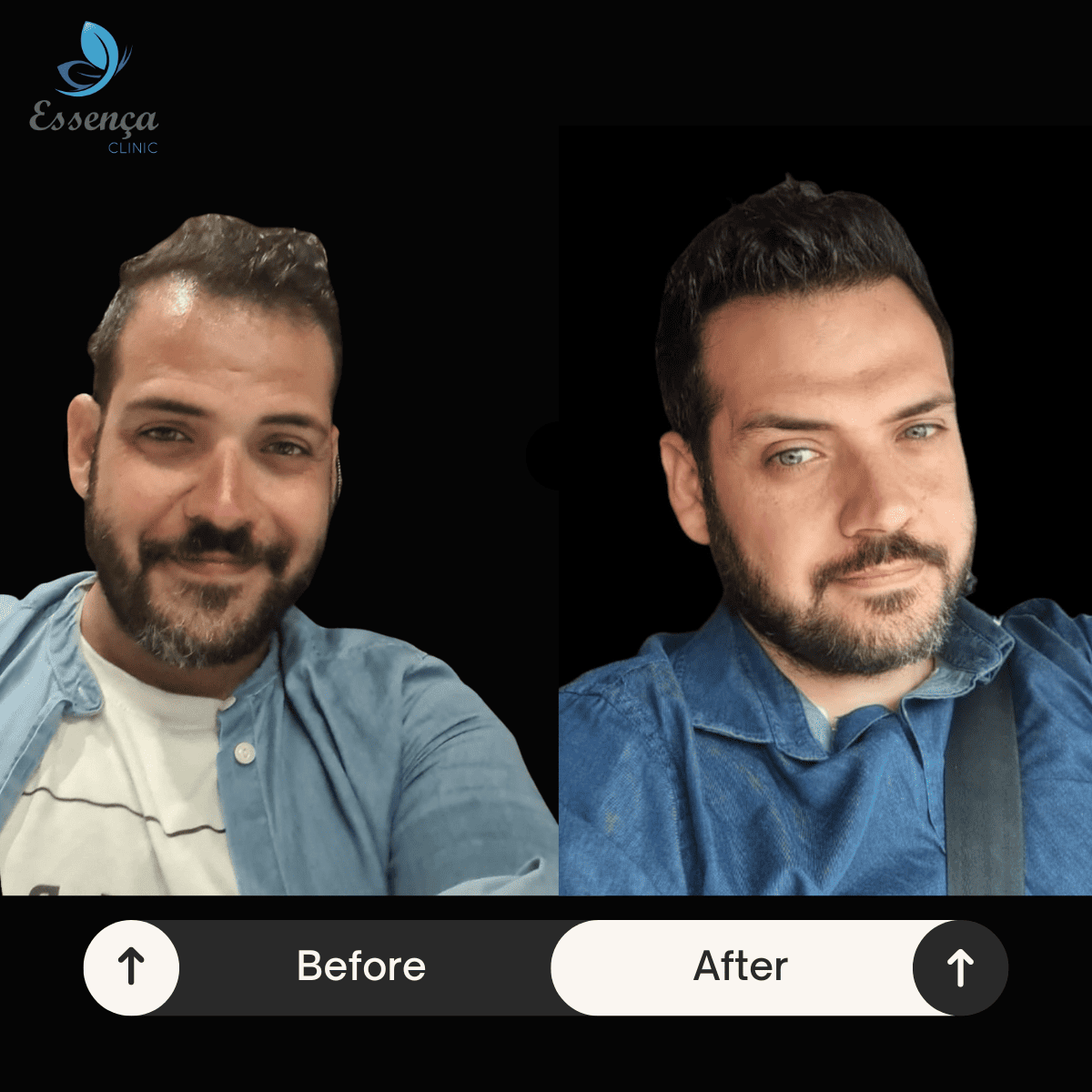 Before After Dr. Mehmet Kapçın (42)