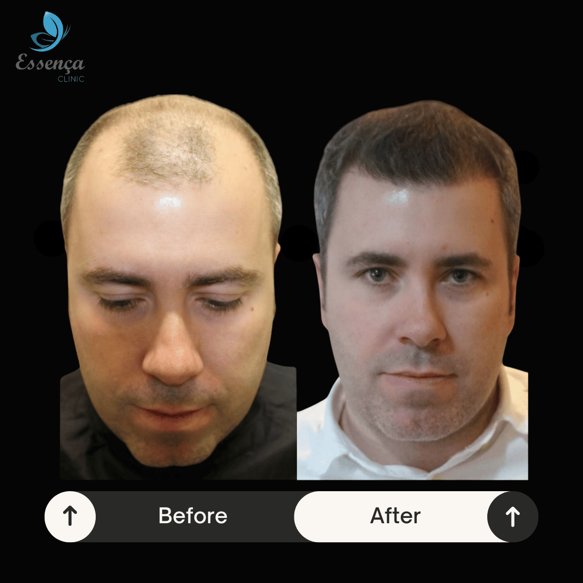 Before After Dr. Mehmet Kapçın (5)
