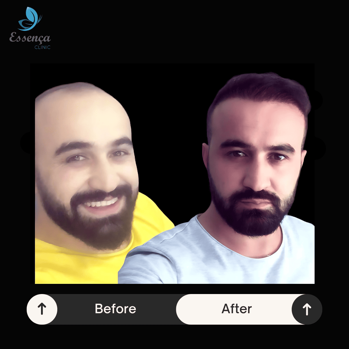 Before After Dr. Mehmet Kapçın (6)