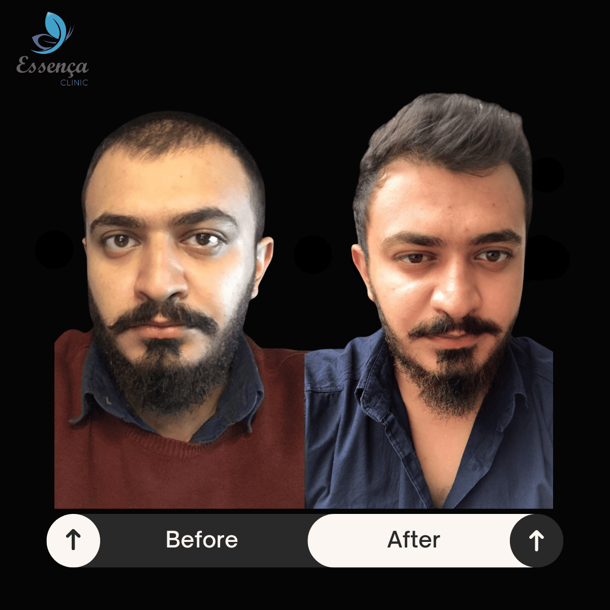 Before After Dr. Mehmet Kapçın (7)