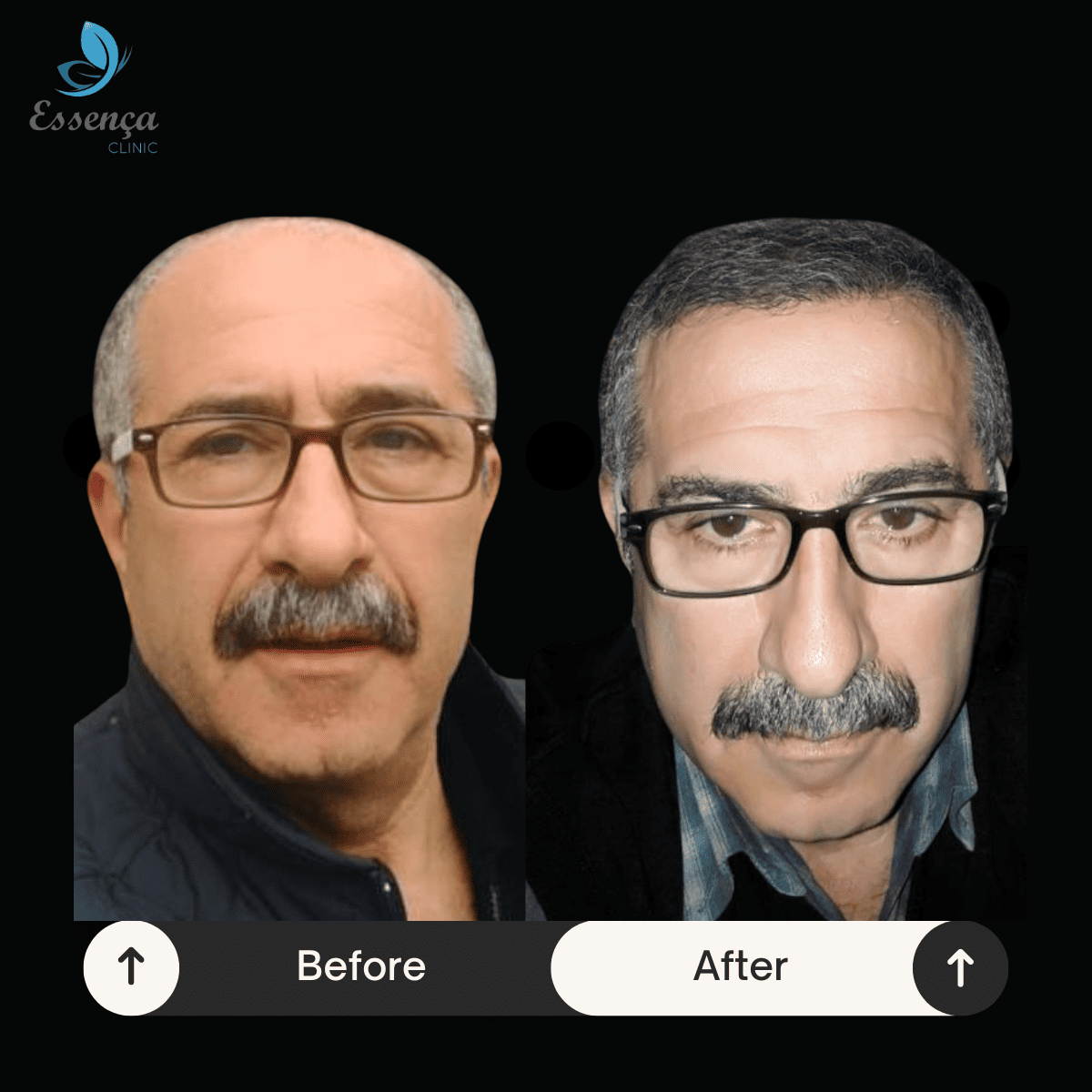 Before After Dr. Mehmet Kapçın (8)