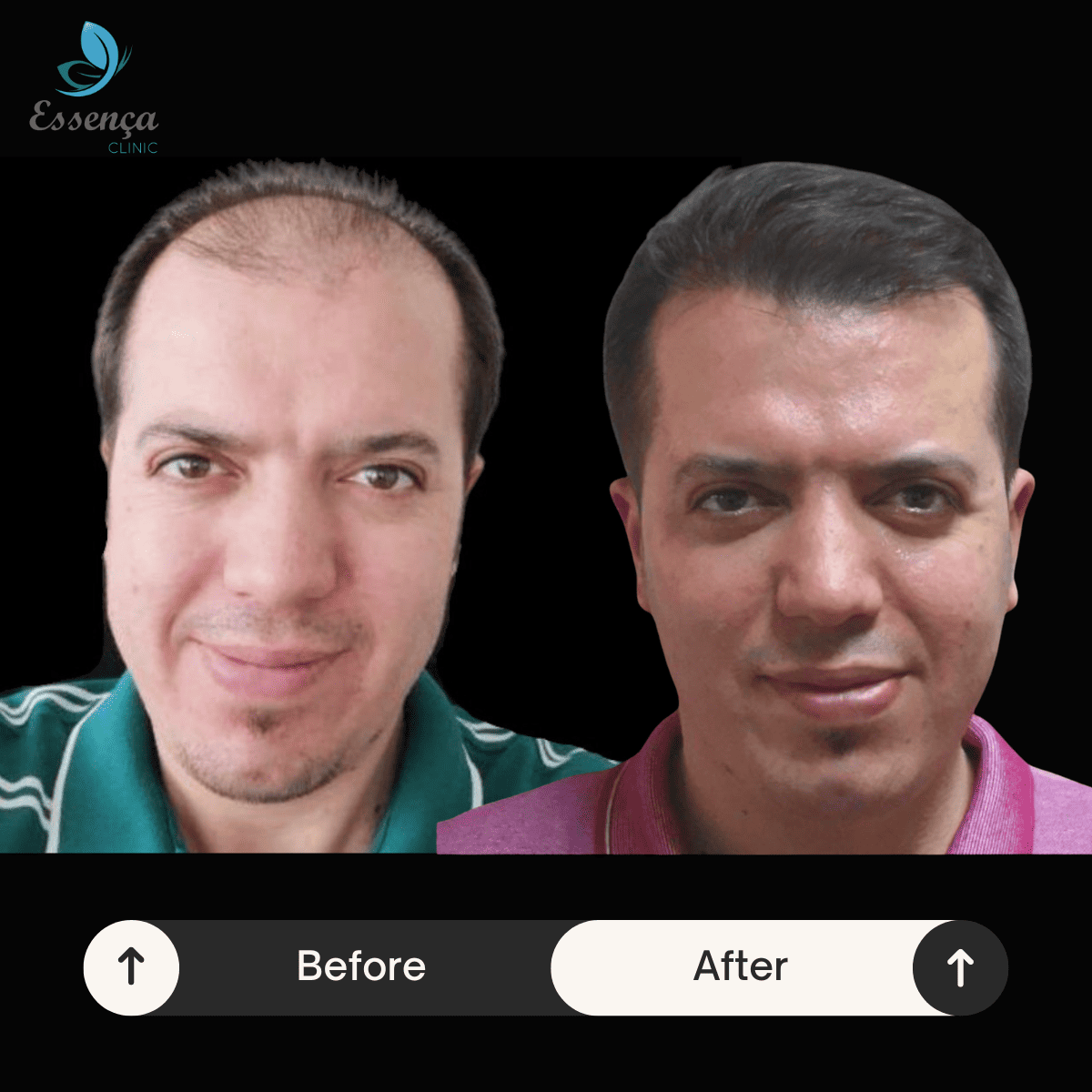 Before After Dr. Mehmet Kapçın (9)