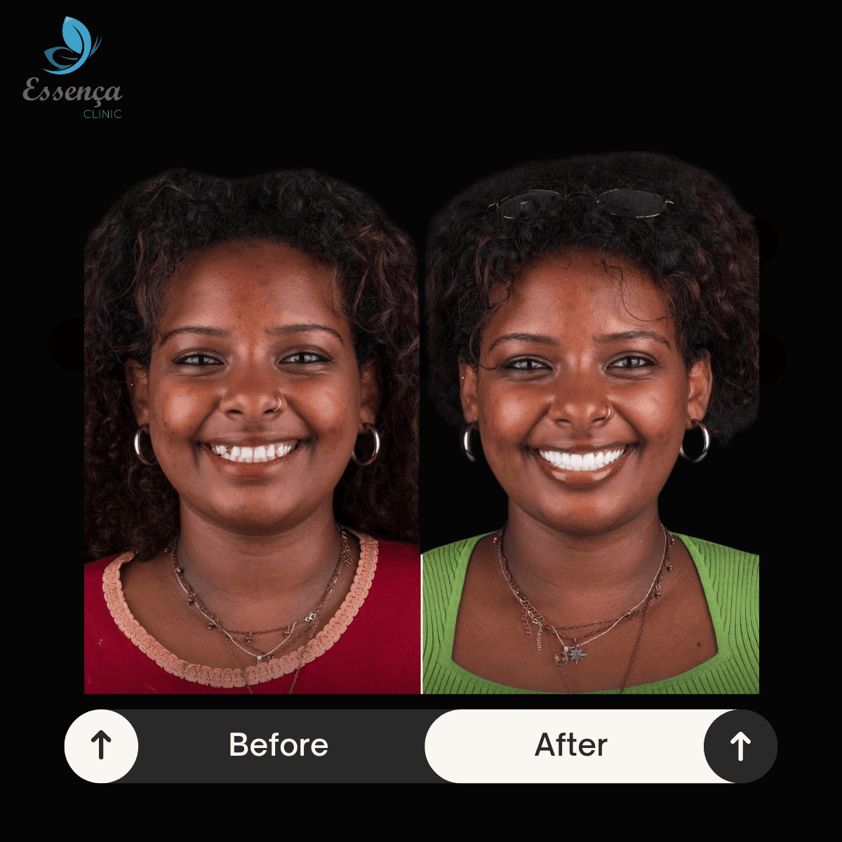 Before After Dr. Remziye Kuşağlı (12)