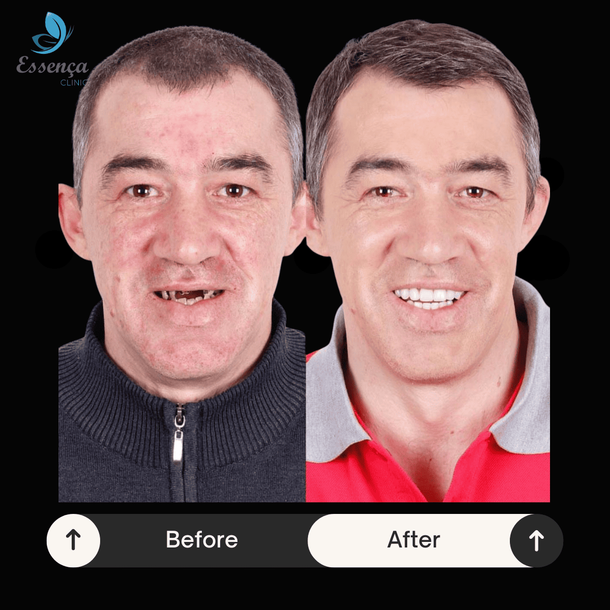 Before After Dr. Remziye Kuşağlı (24)
