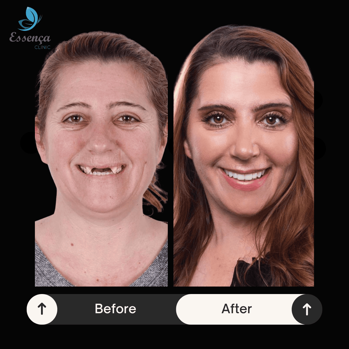 Before After Dr. Remziye Kuşağlı (26)
