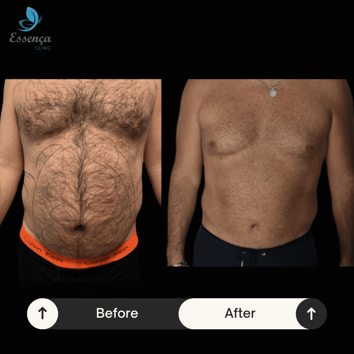 Before After Dr. Sener kucuk (22)-min