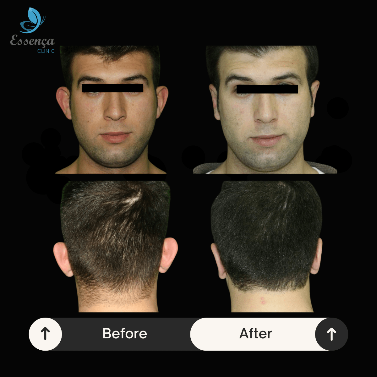 Before After Dr. Sener kucuk (35)-min